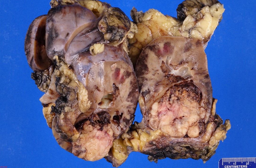 Gross image of kidney