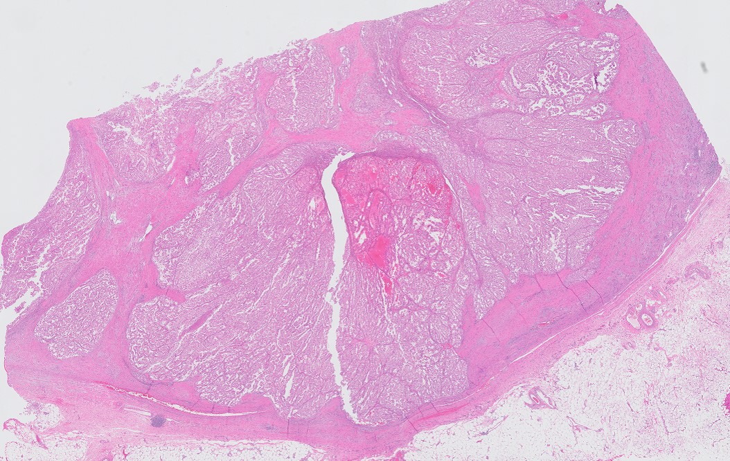 Microscopic image possibly detecting cancerous areas in human tissue