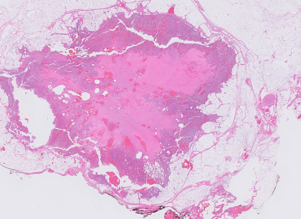 Microscopic image possibly detecting cancerous areas in human tissue