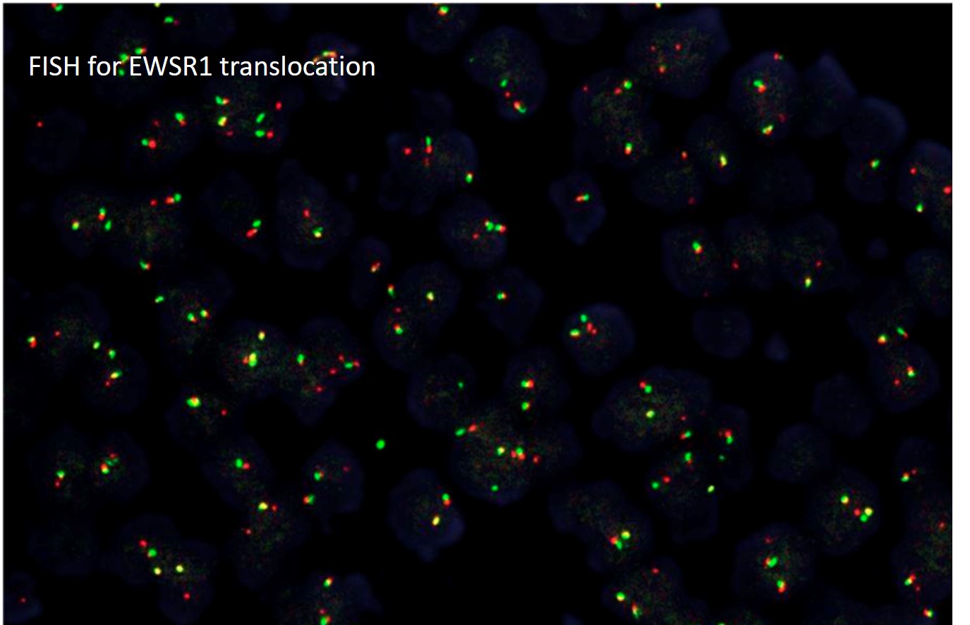 Microscopic image possibly detecting cancerous areas in human tissue