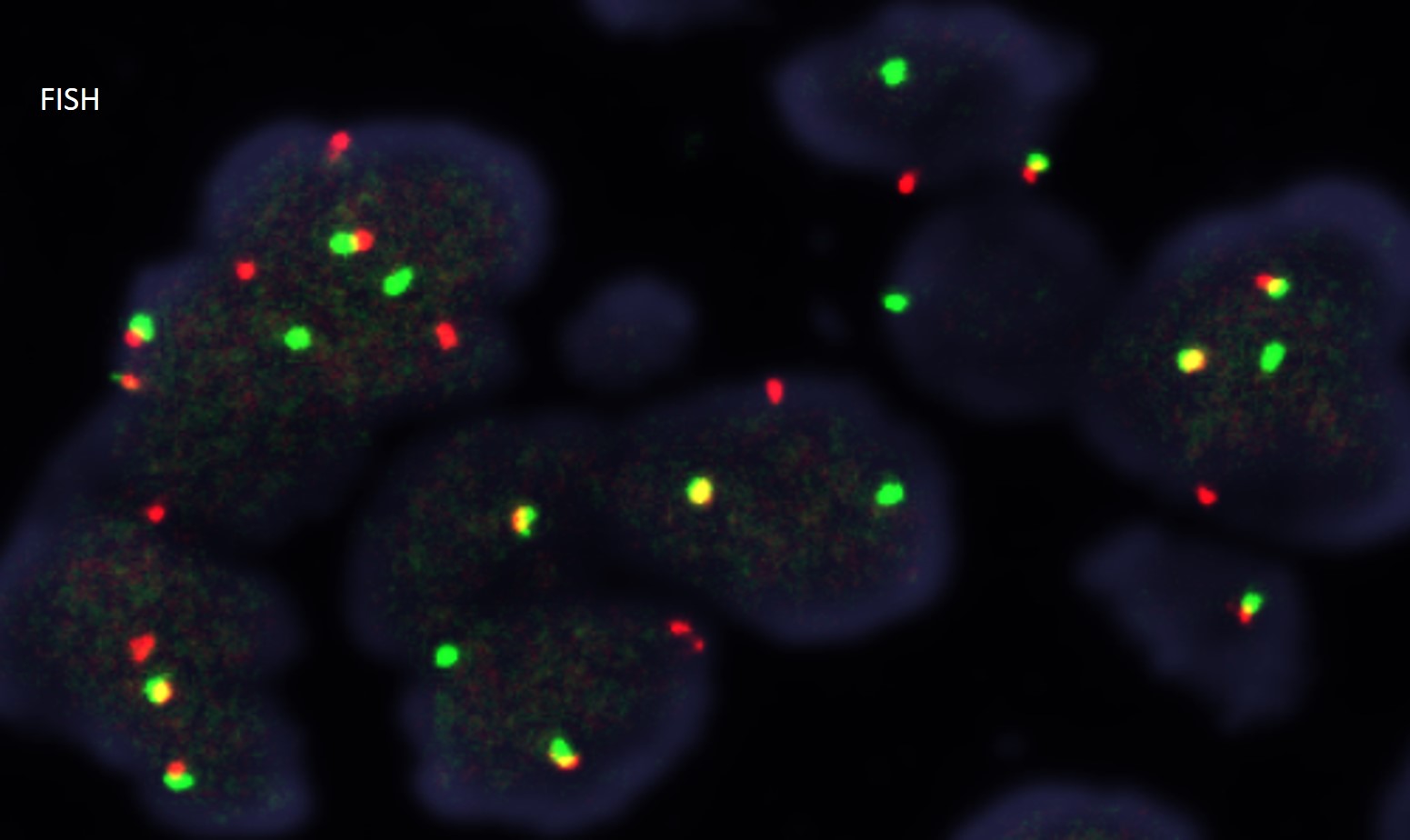 Microscopic image possibly detecting cancerous areas in human tissue