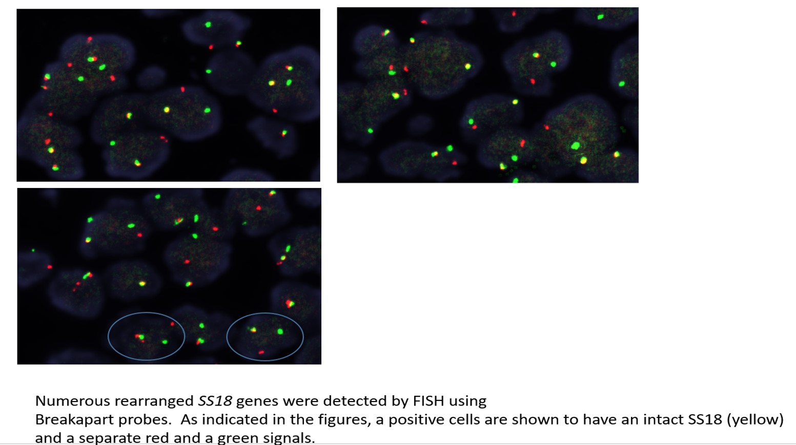 Microscopic image possibly detecting cancerous areas in human tissue