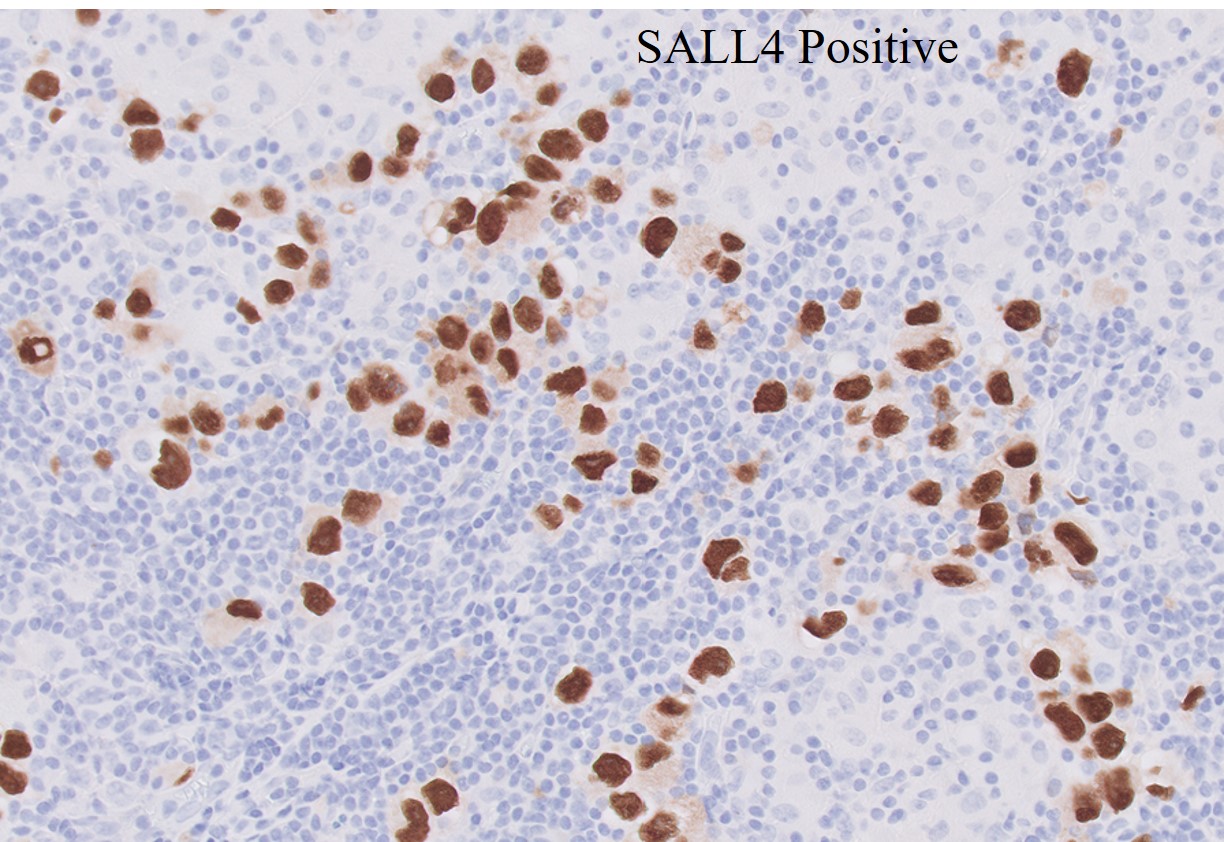 Microscopic image possibly detecting cancerous areas in human tissue