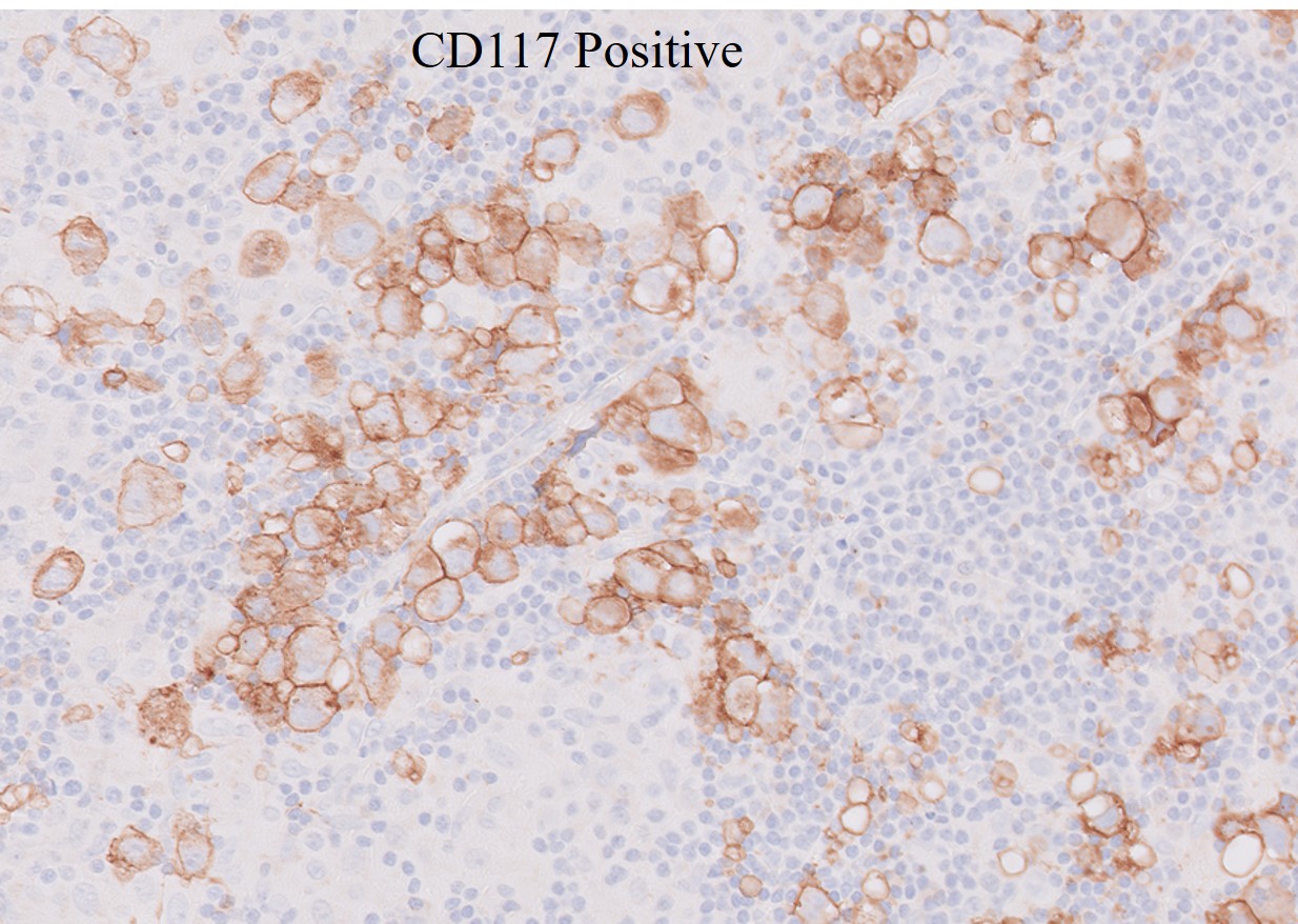 Microscopic image possibly detecting cancerous areas in human tissue