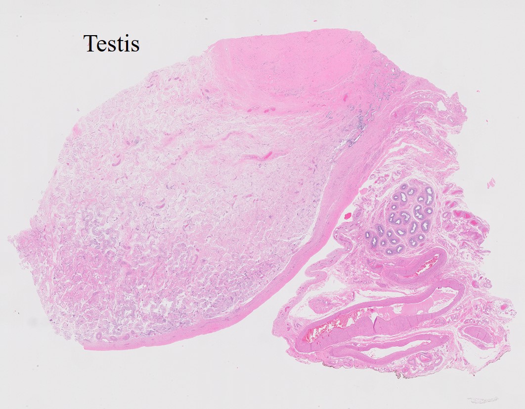 Microscopic image possibly detecting cancerous areas in human tissue