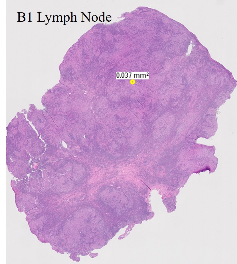 Microscopic image possibly detecting cancerous areas in human tissue