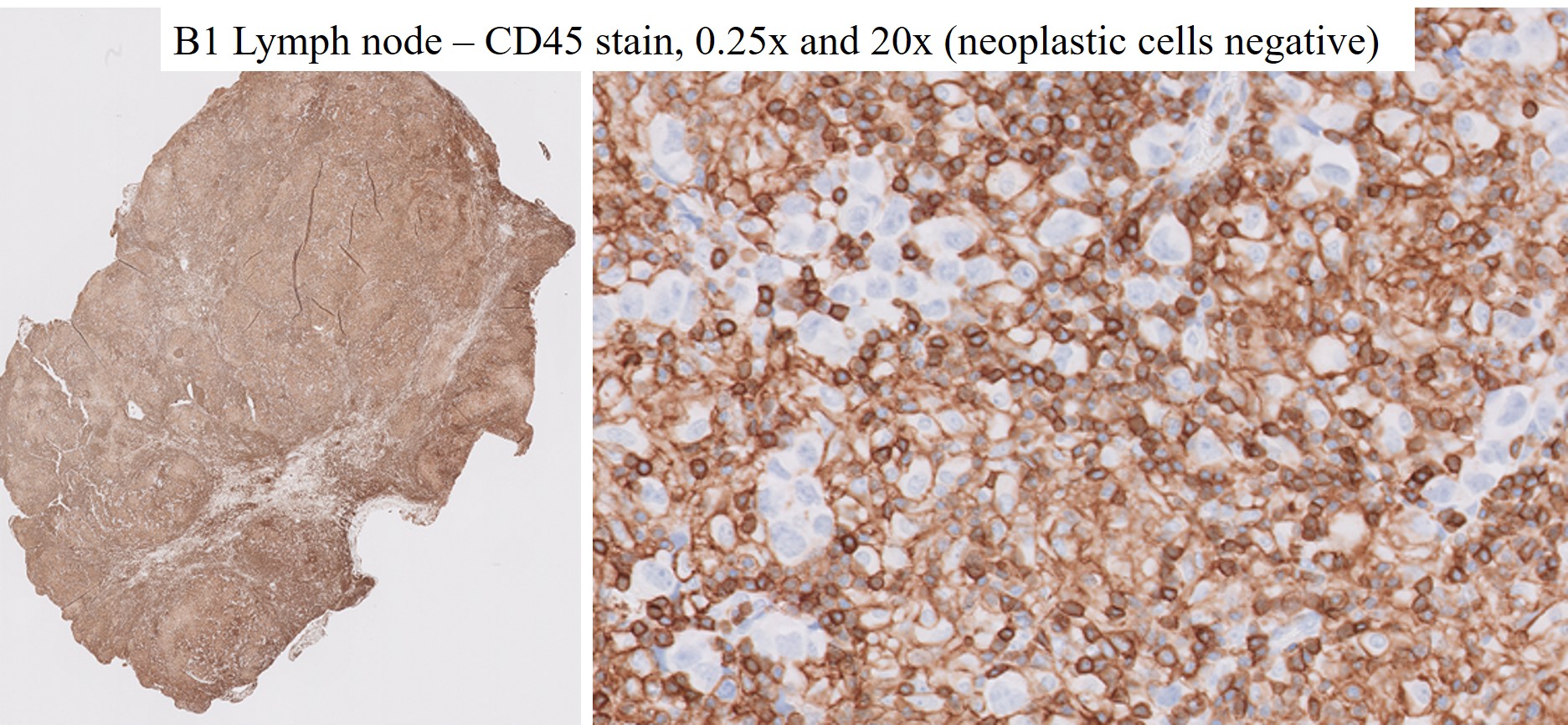 Microscopic image possibly detecting cancerous areas in human tissue