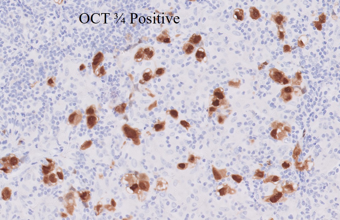 Microscopic image possibly detecting cancerous areas in human tissue