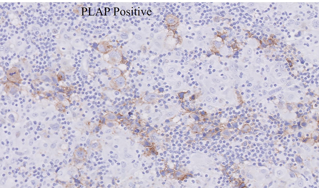 Microscopic image possibly detecting cancerous areas in human tissue