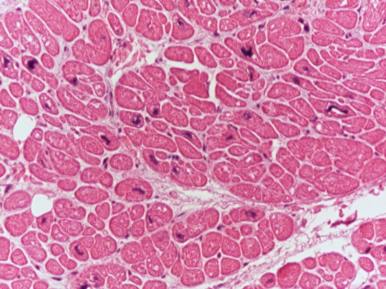 Microscopic image possibly detecting cancerous areas in human tissue