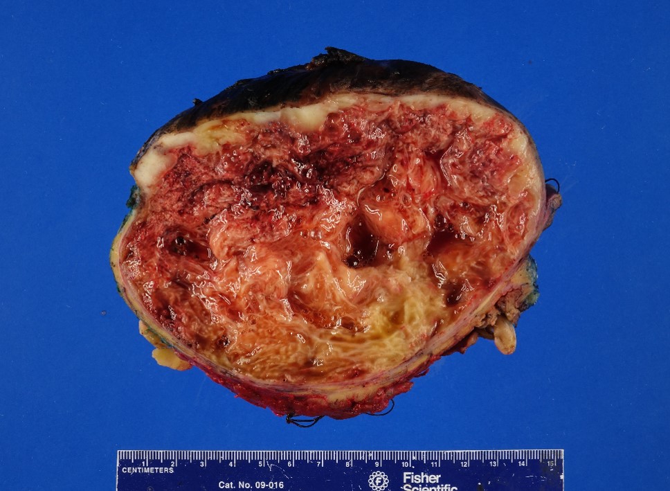 Gross image of left thigh mass