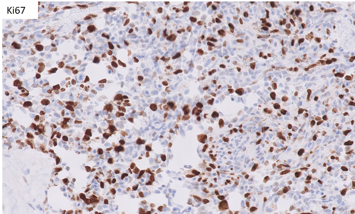 Table describing IHC workups on renal mass