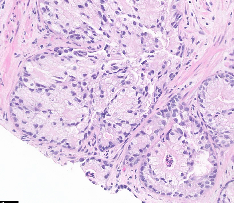 Microscopic image possibly detecting cancerous areas in human tissue