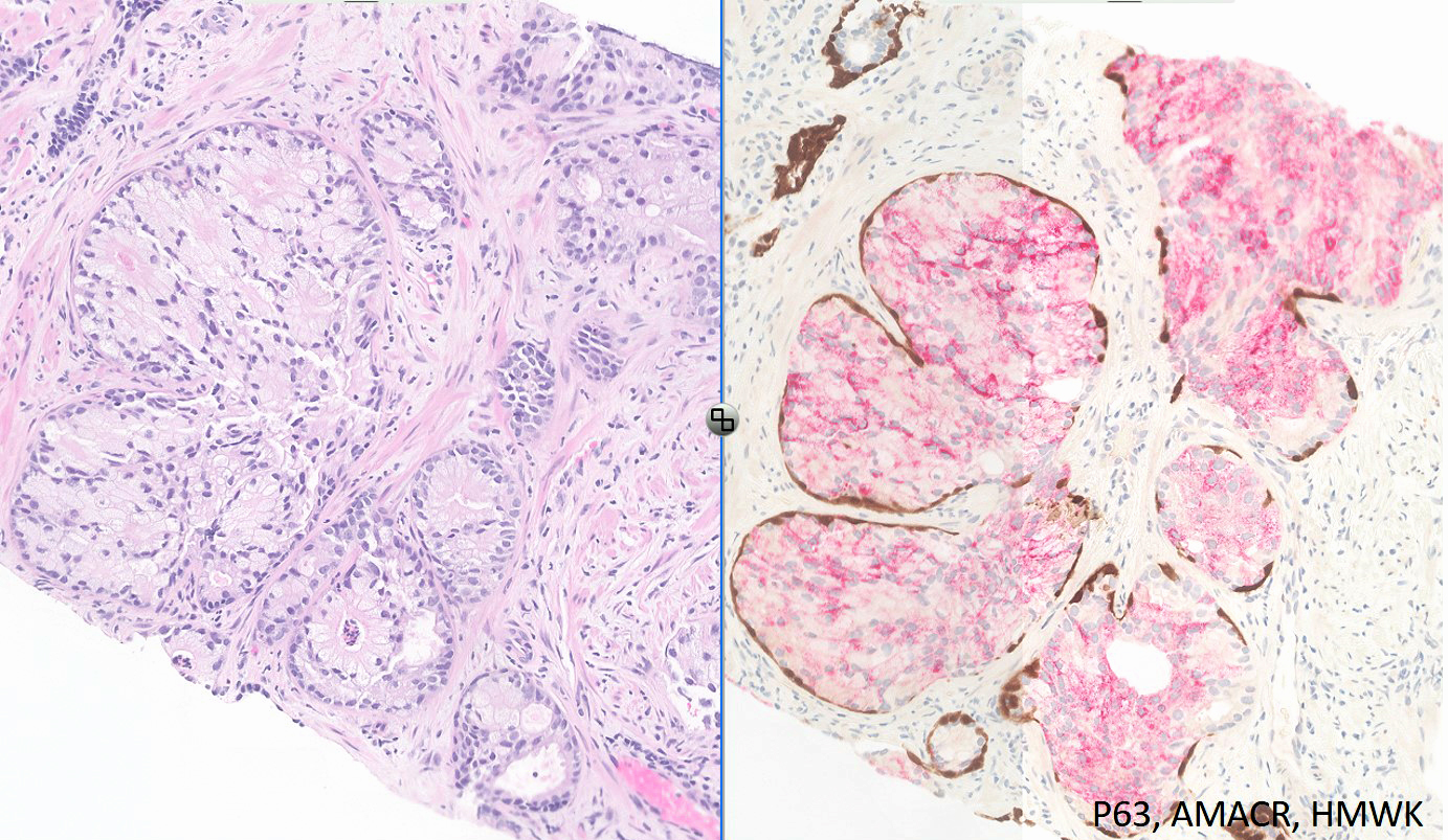 Microscopic image possibly detecting cancerous areas in human tissue