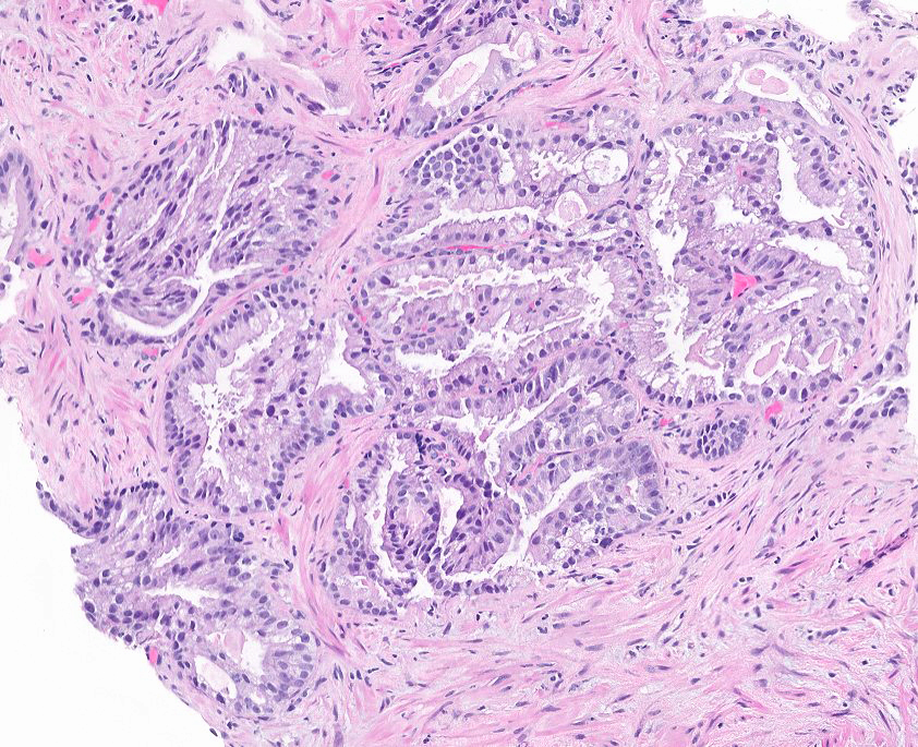 Microscopic image possibly detecting cancerous areas in human tissue