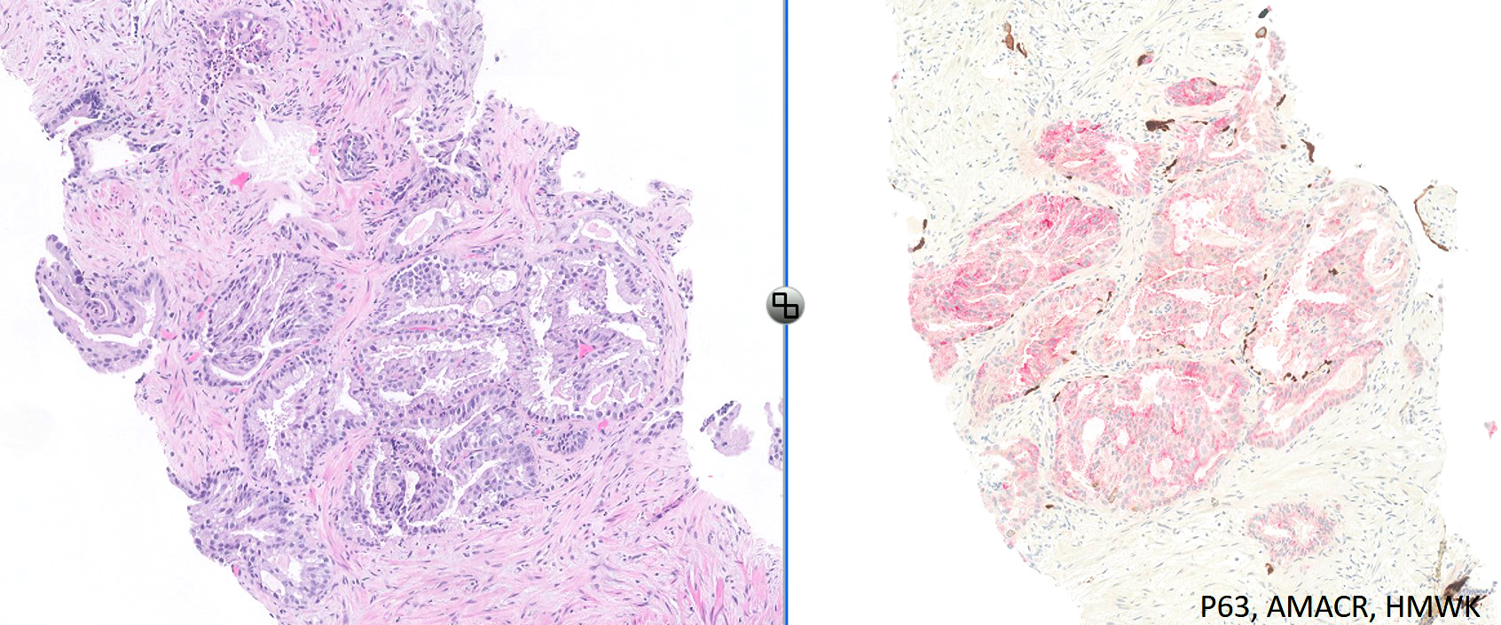 Microscopic image possibly detecting cancerous areas in human tissue