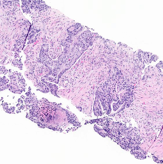 Microscopic image possibly detecting cancerous areas in human tissue