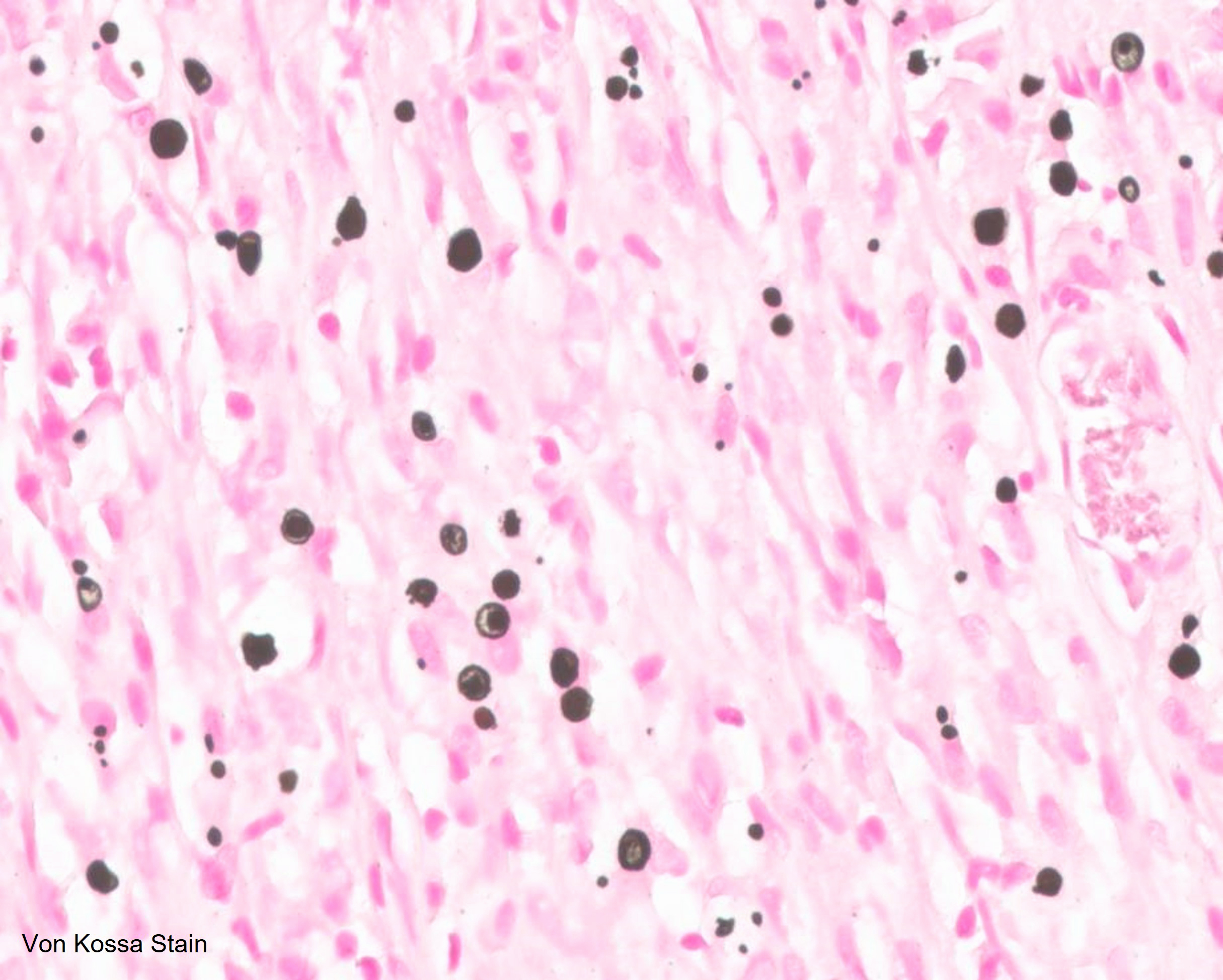 Microscopic image possibly detecting cancerous areas in human tissue