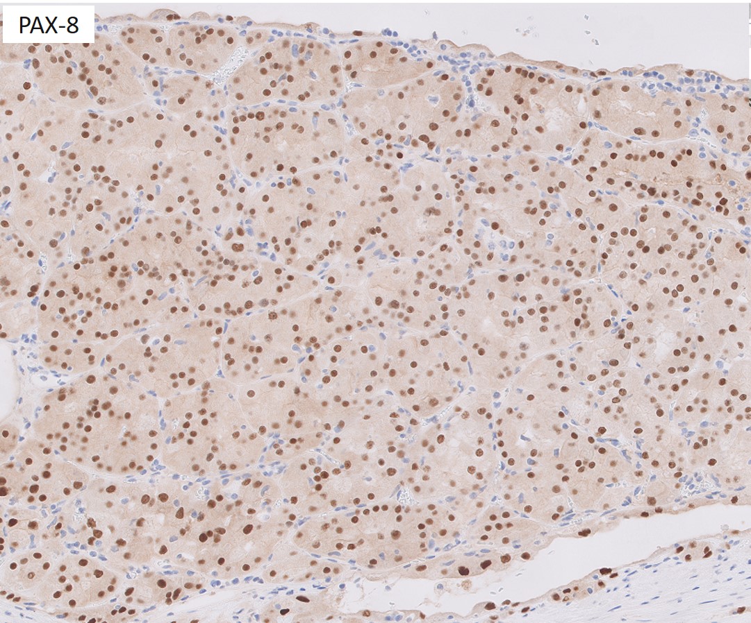 Microscopic image possibly detecting cancerous areas in human tissue