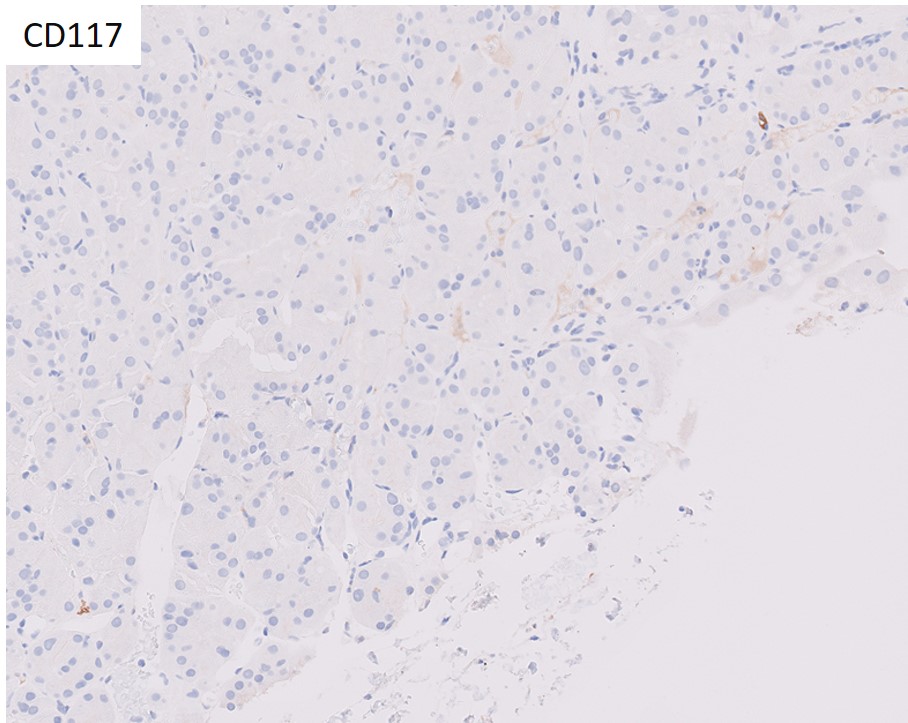 Microscopic image possibly detecting cancerous areas in human tissue