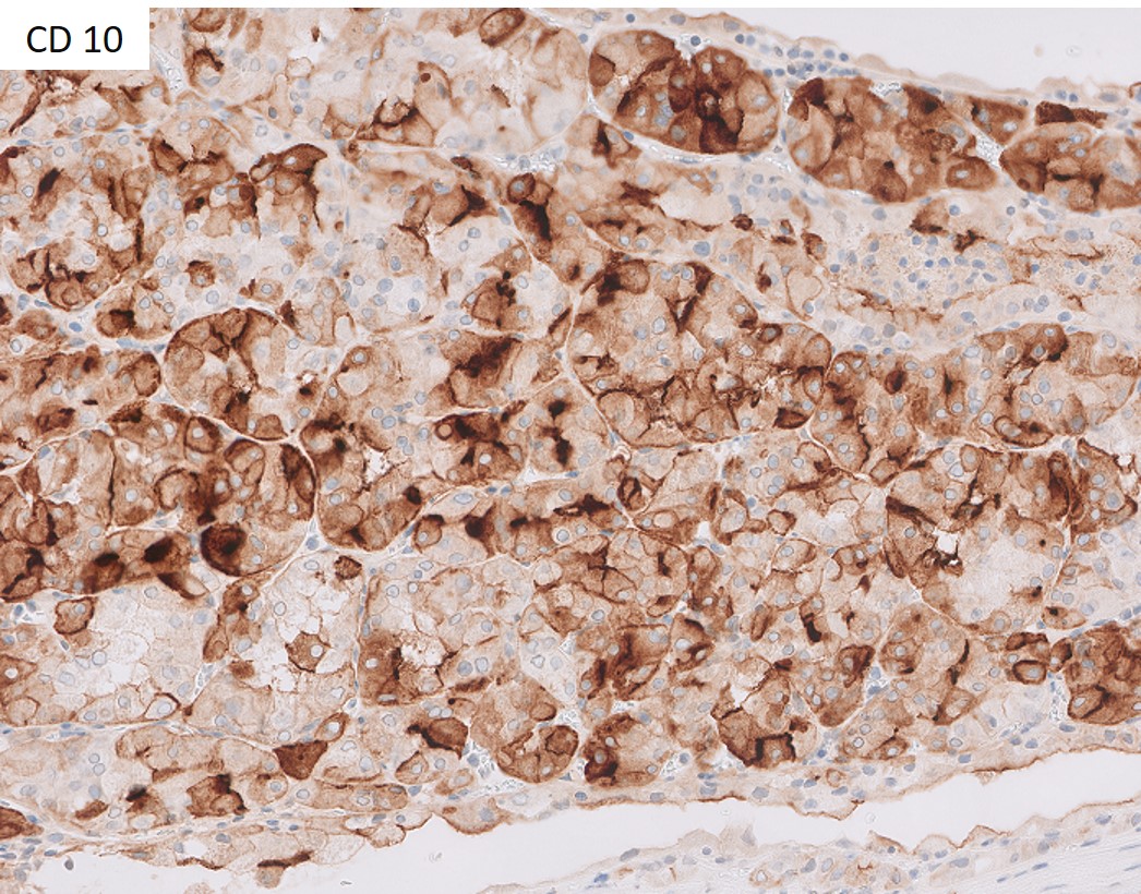 Microscopic image possibly detecting cancerous areas in human tissue