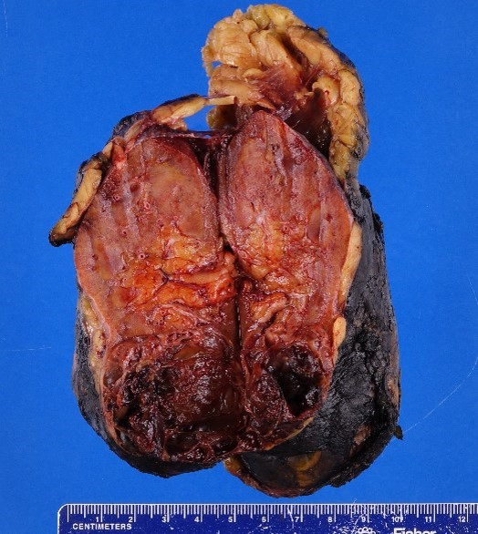 Gross image of kidney