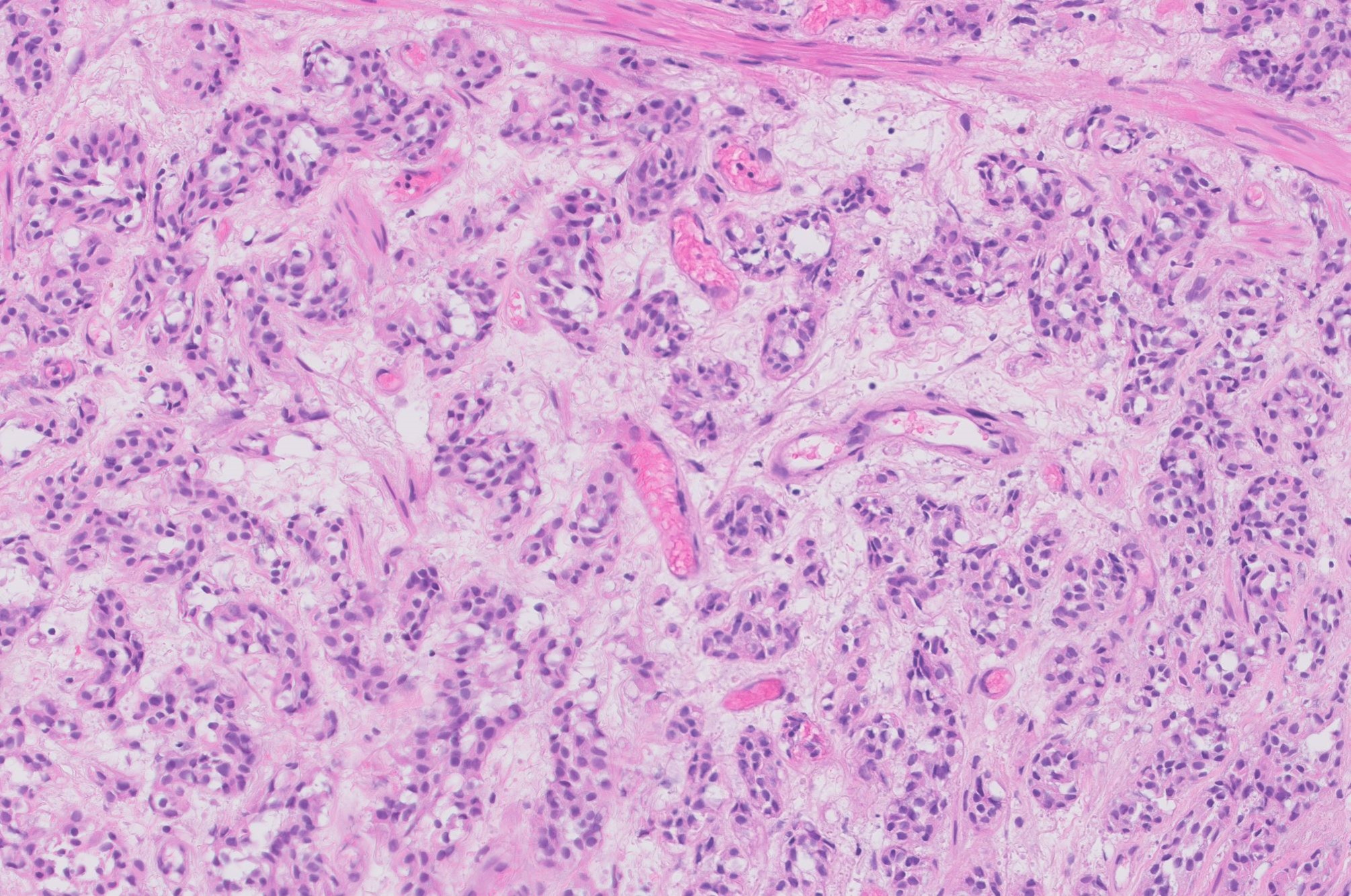 Microscopic image possibly detecting cancerous areas in human tissue