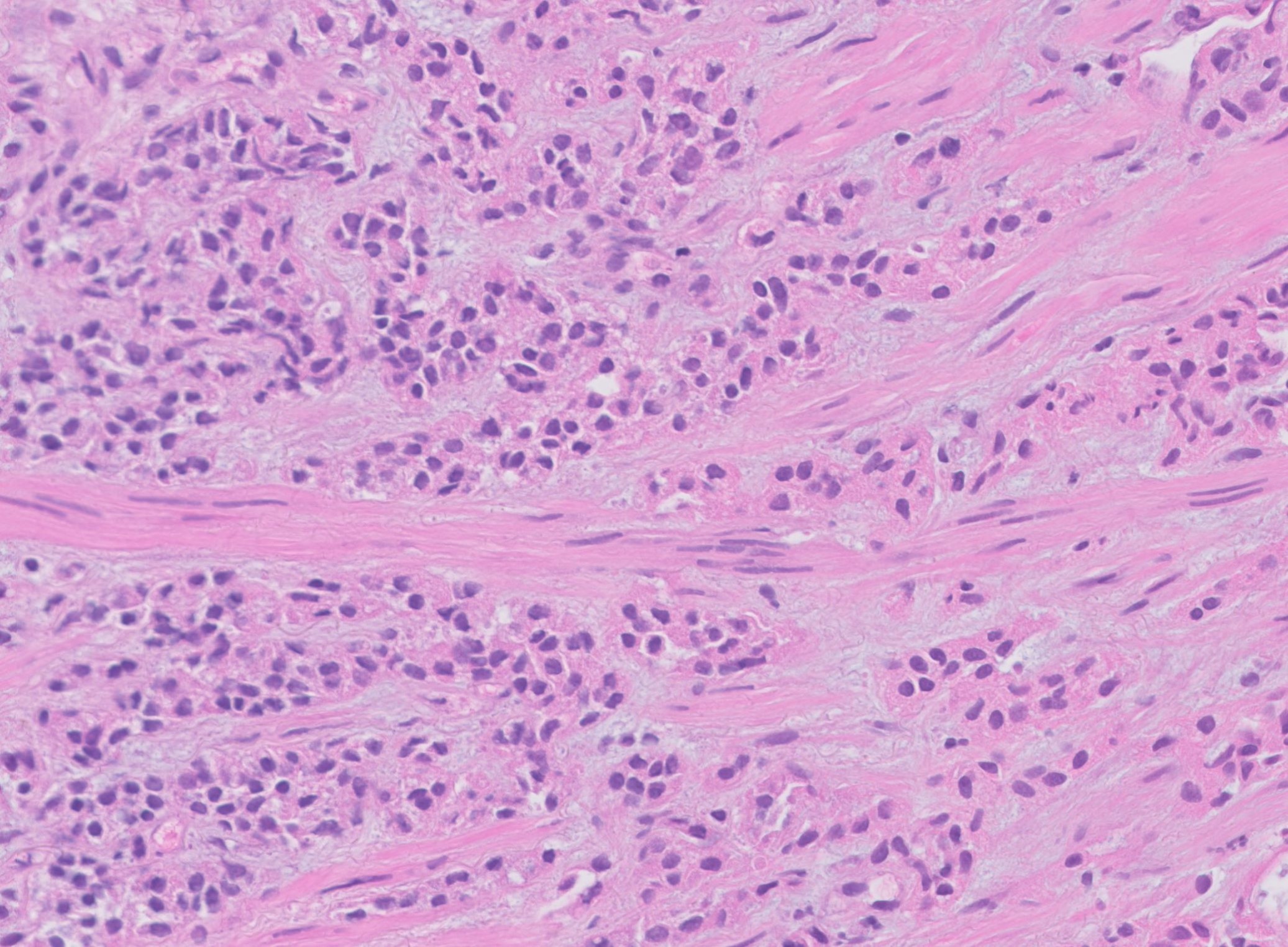 Microscopic image possibly detecting cancerous areas in human tissue