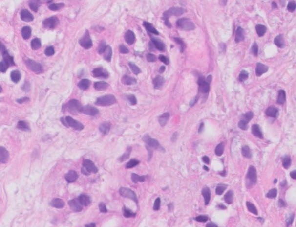 Microscopic image possibly detecting cancerous areas in human tissue