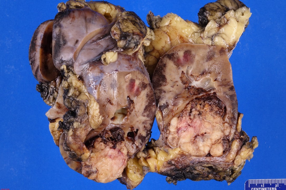 Gross image of kidney