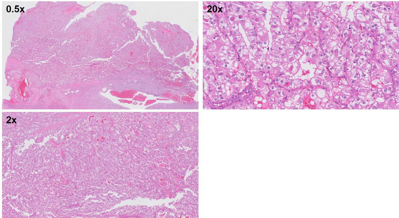 Microscopic image possibly detecting cancerous areas in human tissue