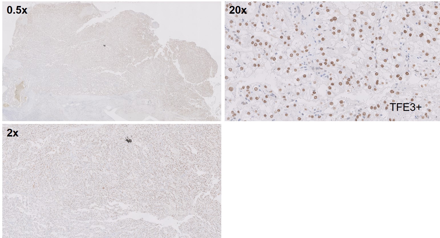 Microscopic image possibly detecting cancerous areas in human tissue