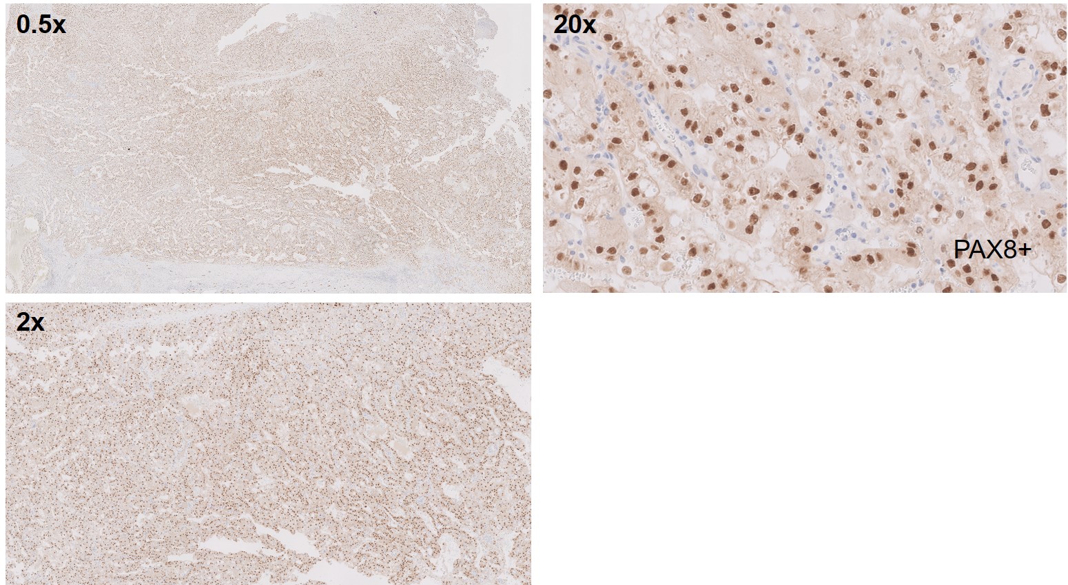 Microscopic image possibly detecting cancerous areas in human tissue