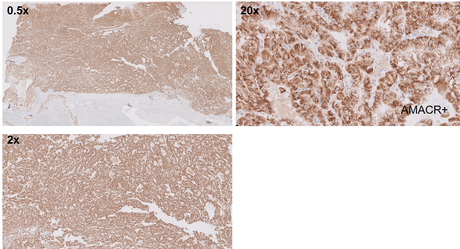 Microscopic image possibly detecting cancerous areas in human tissue