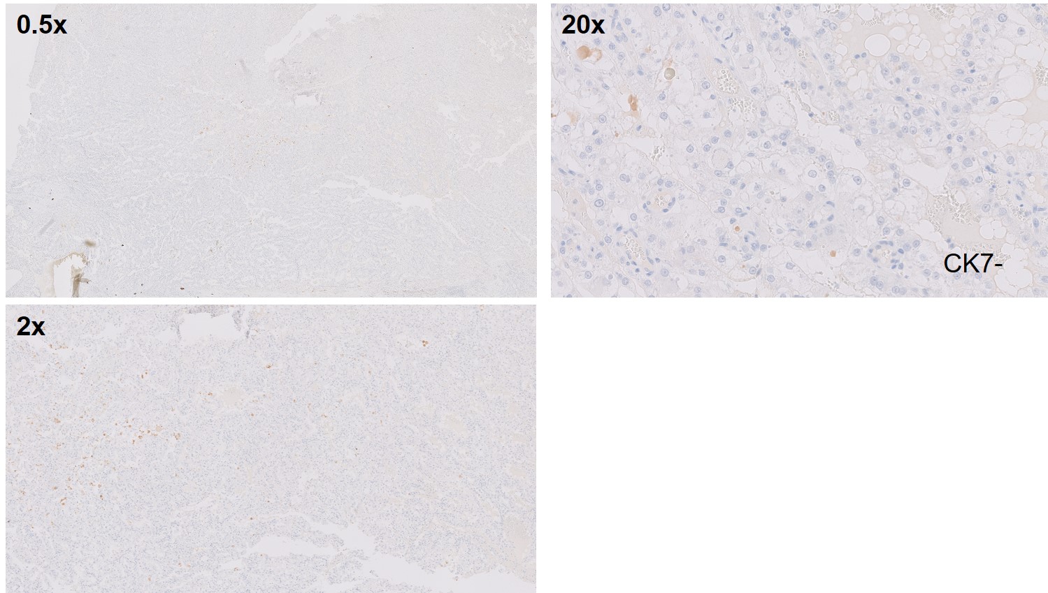 Microscopic image possibly detecting cancerous areas in human tissue