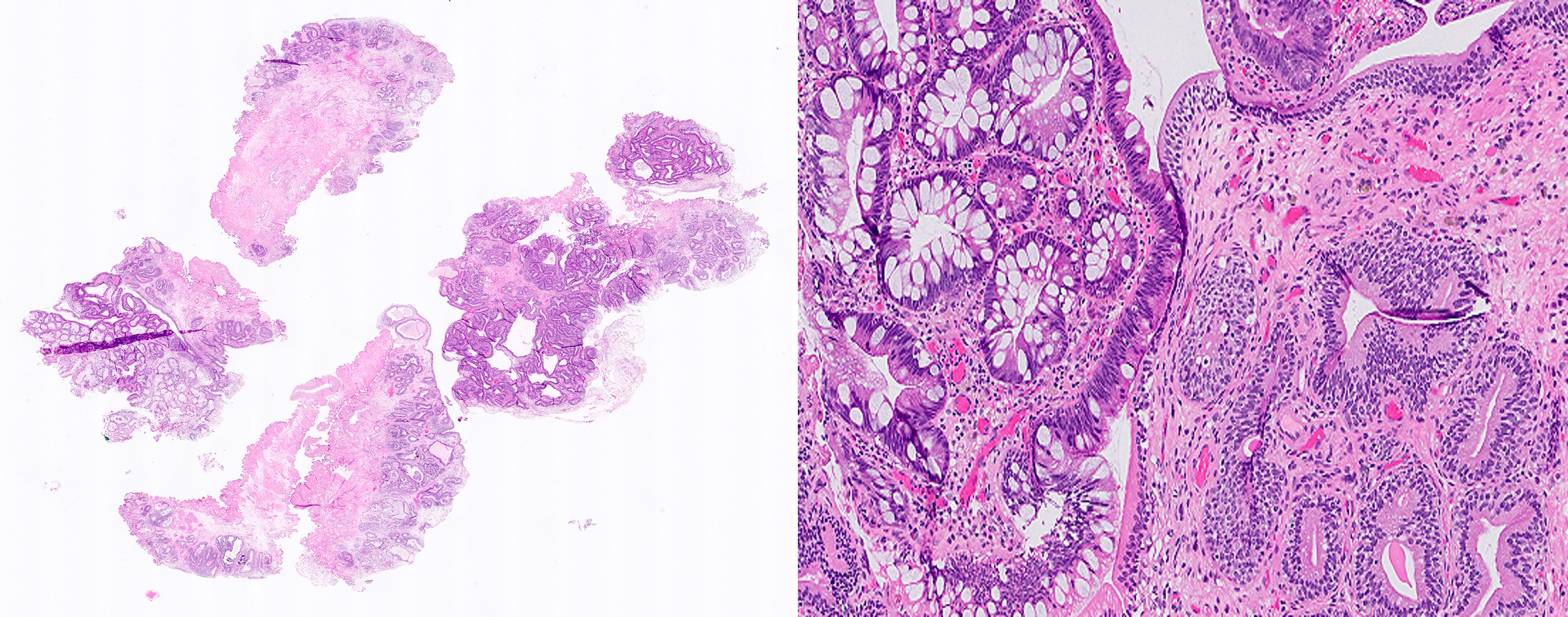 Microscopic image possibly detecting cancerous areas in human tissue