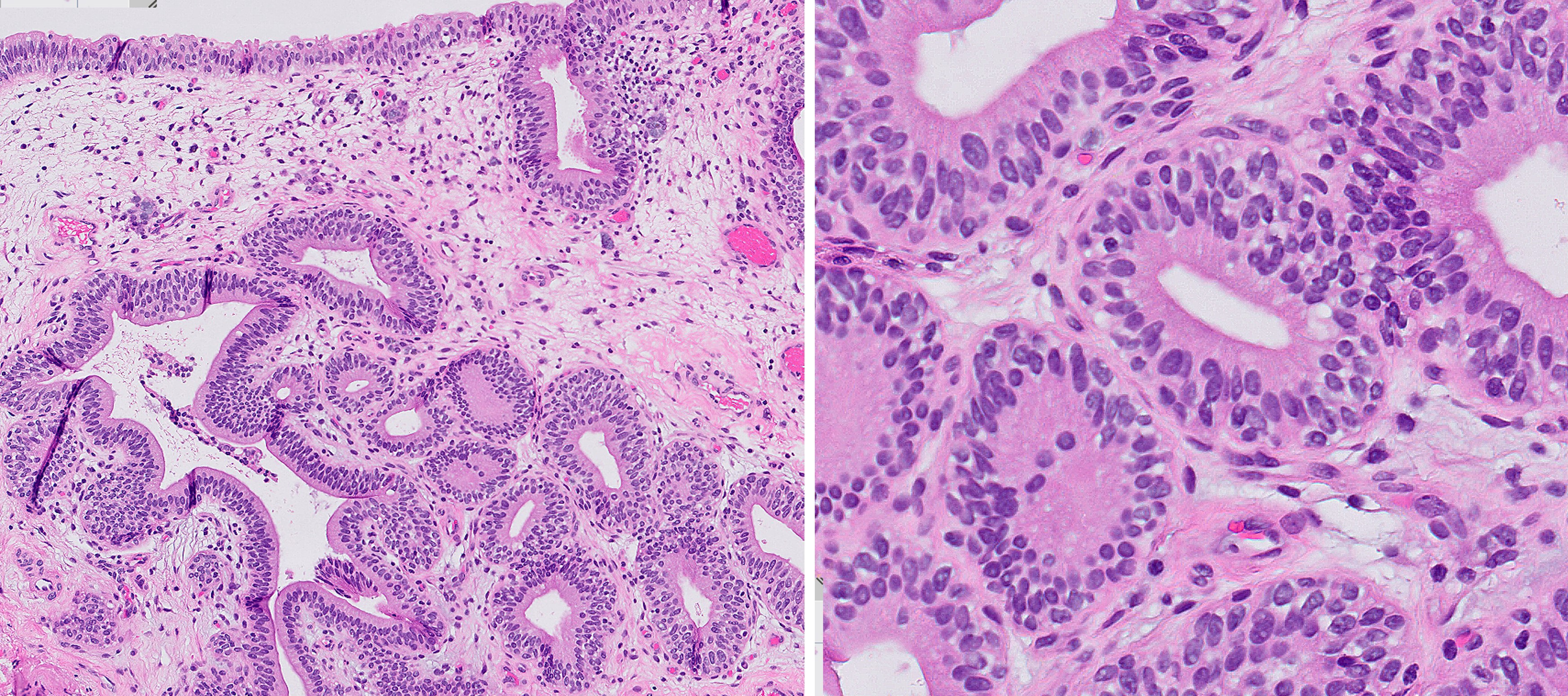 Microscopic image possibly detecting cancerous areas in human tissue