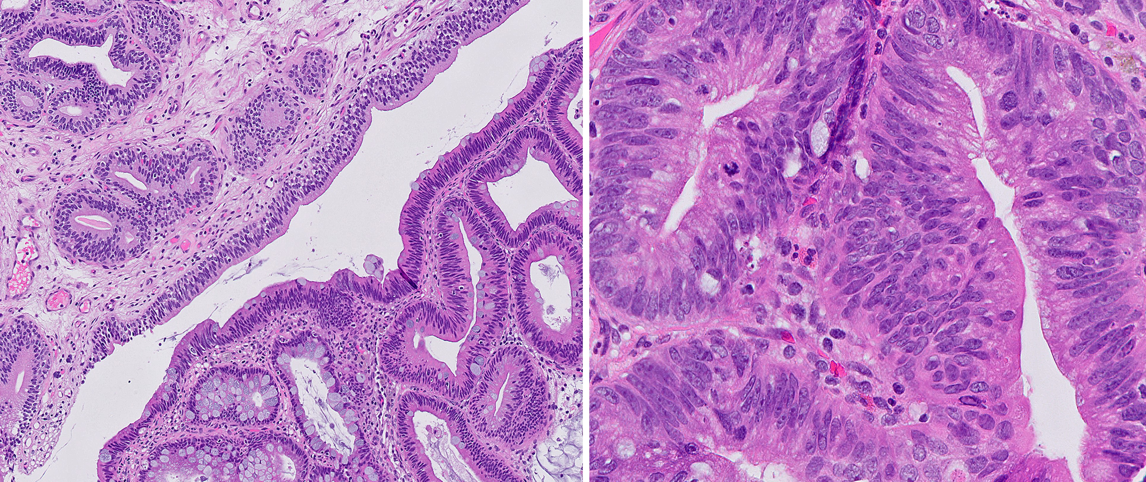 Microscopic image possibly detecting cancerous areas in human tissue