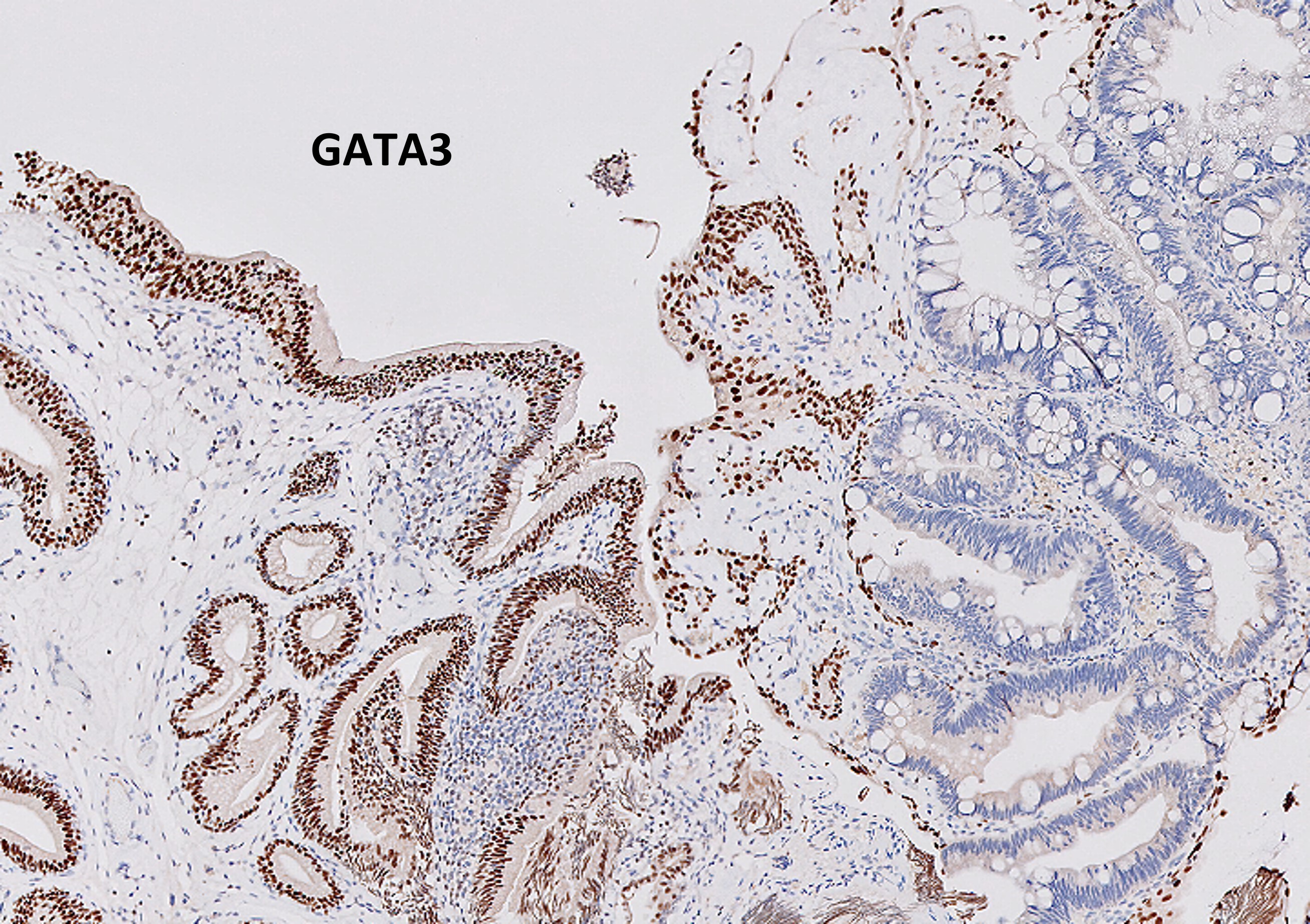 Microscopic image possibly detecting cancerous areas in human tissue