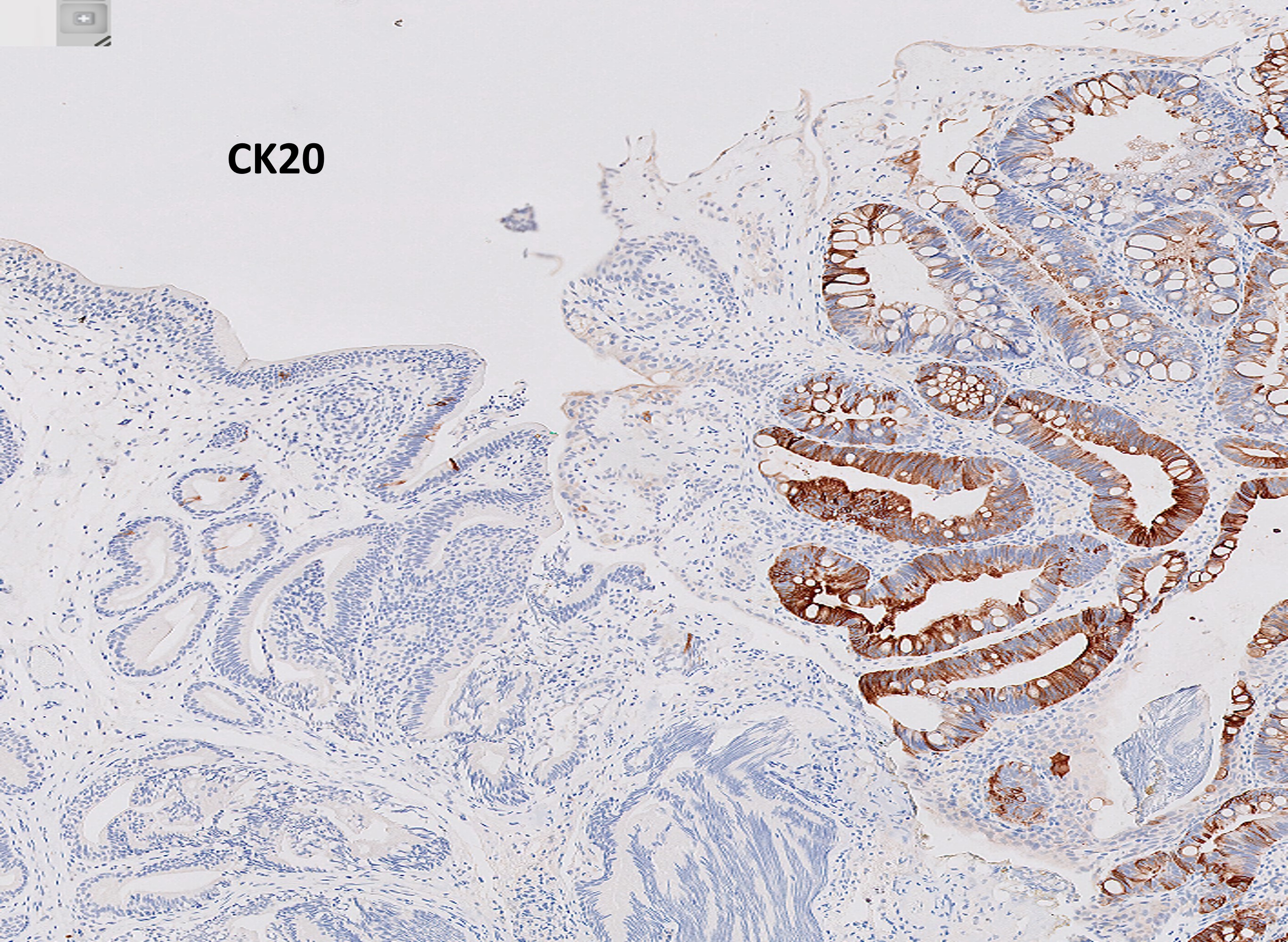 Microscopic image possibly detecting cancerous areas in human tissue