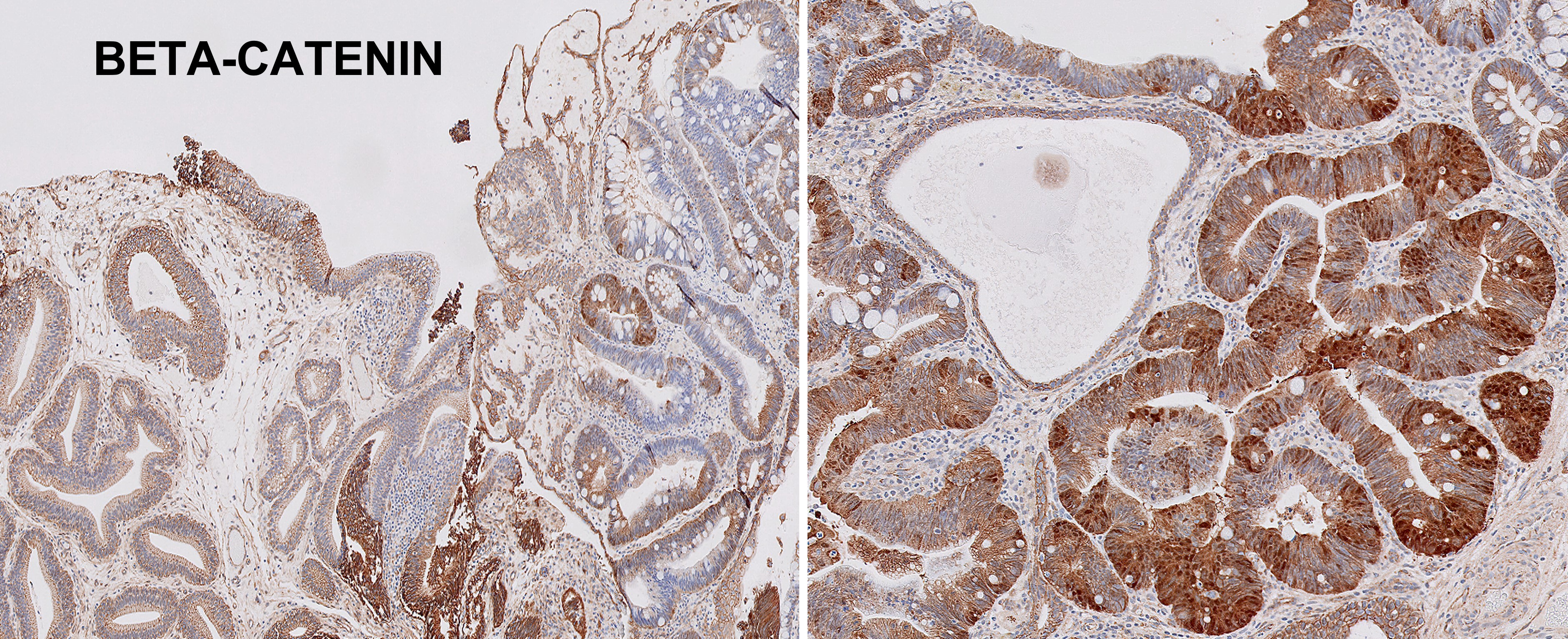 Microscopic image possibly detecting cancerous areas in human tissue