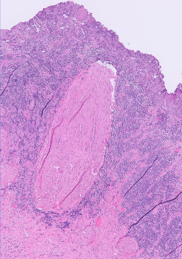 Microscopic image possibly detecting cancerous areas in human tissue