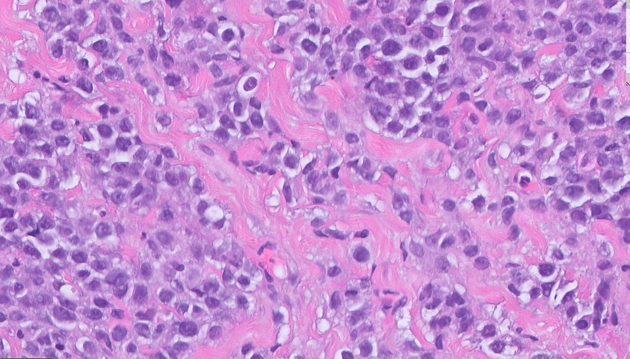 Microscopic image possibly detecting cancerous areas in human tissue