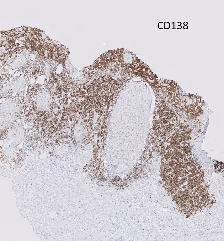 Microscopic image possibly detecting cancerous areas in human tissue