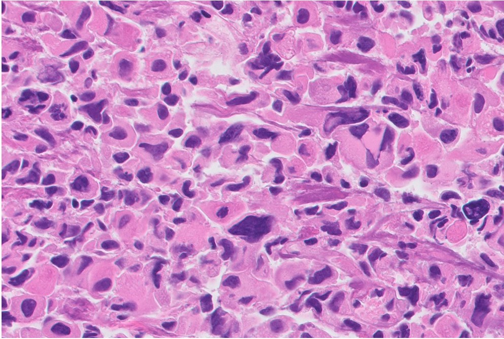 Microscopic image possibly detecting cancerous areas in human tissue