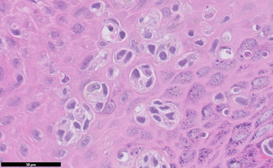 Microscopic image possibly detecting cancerous areas in human tissue