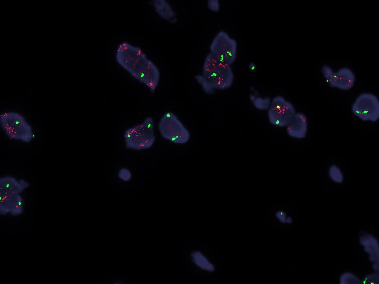 Microscopic image possibly detecting cancerous areas in human tissue