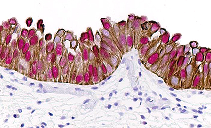 Microscopic image possibly detecting cancerous areas in human tissue